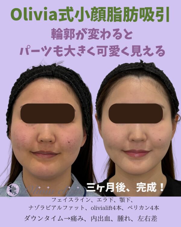 140 Olivia式小顔脂肪吸引 × ナゾラビアルファット除去 × ペリカンリフト × Olivia lift