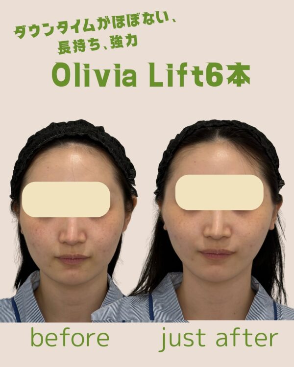 143 Olivia lift