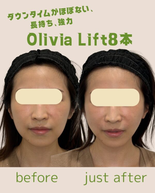 144 Olivia lift