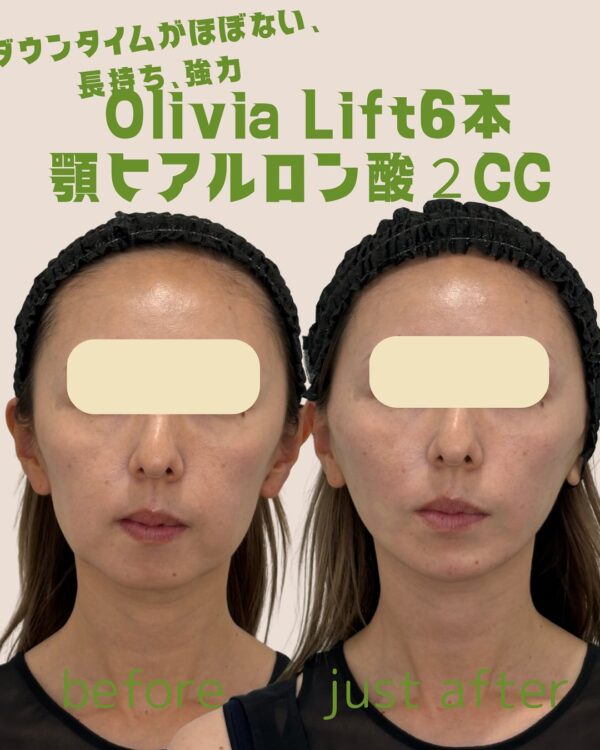 146 Olivia lift × ヒアルロン酸