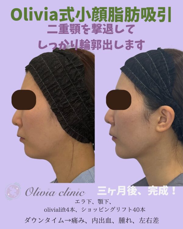 148 Olivia式小顔脂肪吸引 × ショッピングリフト × Olivia lift