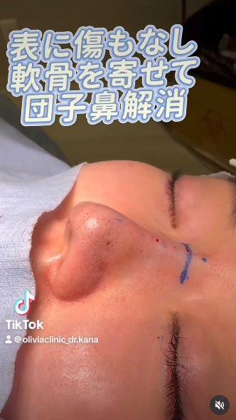 149 切らない鼻尖形成 × ヒアルロン酸