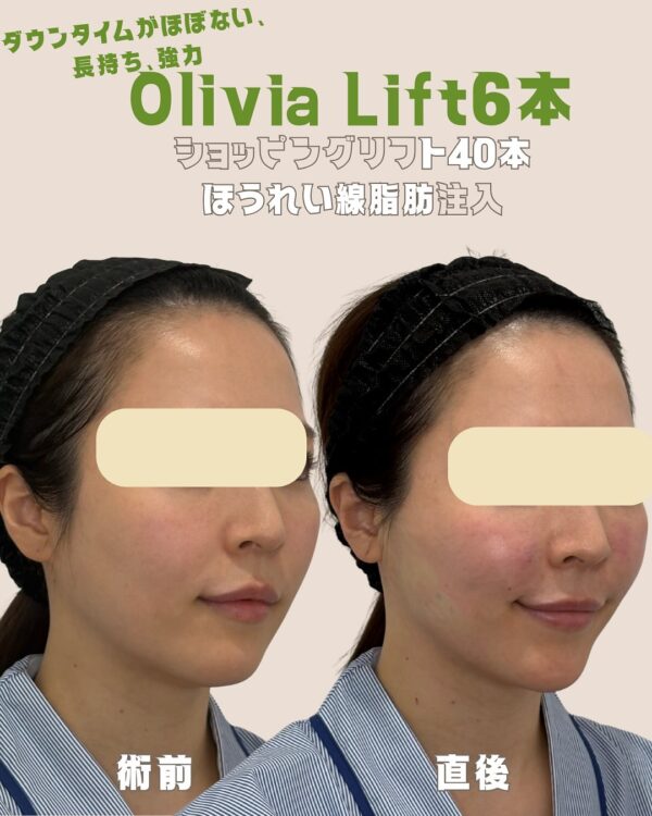 150 Olivia lift × ショッピングリフト × ほうれい線脂肪注入
