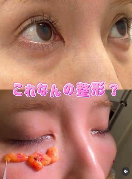 152 クマ取り × コンデンスリッチ注入