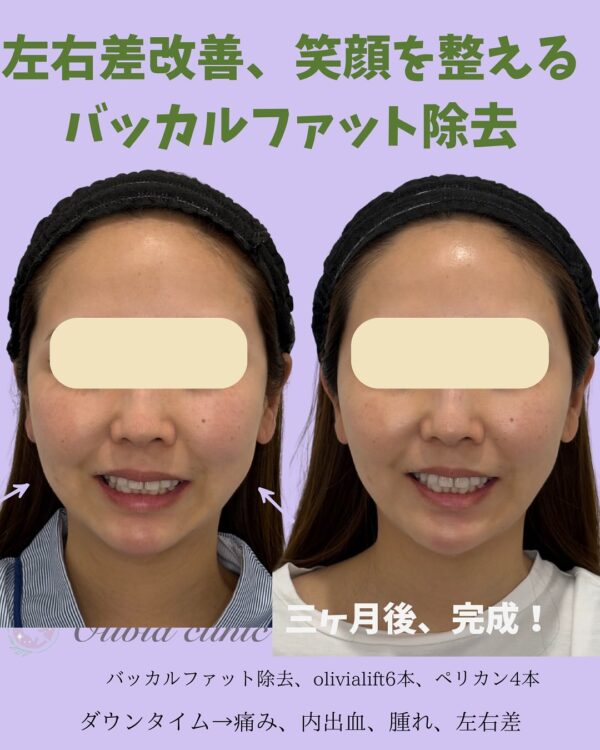 153 バッカルファット除去 × ペリカンリフト × Olivia lift