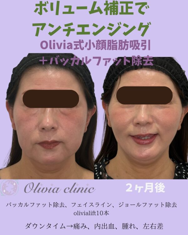 156 Olivia式小顔脂肪吸引 × バッカルファット除去 × ジョールファット除去 × Olivia lift