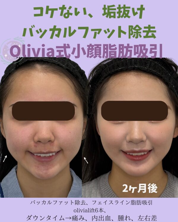 158 Olivia式小顔脂肪吸引 × バッカルファット除去  × Olivia lift