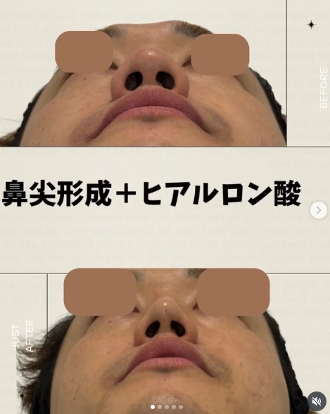 160 切らない鼻尖形成 × ヒアルロン酸