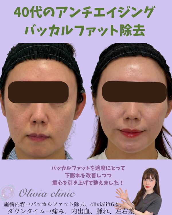 161 バッカルファット除去  × Olivia lift