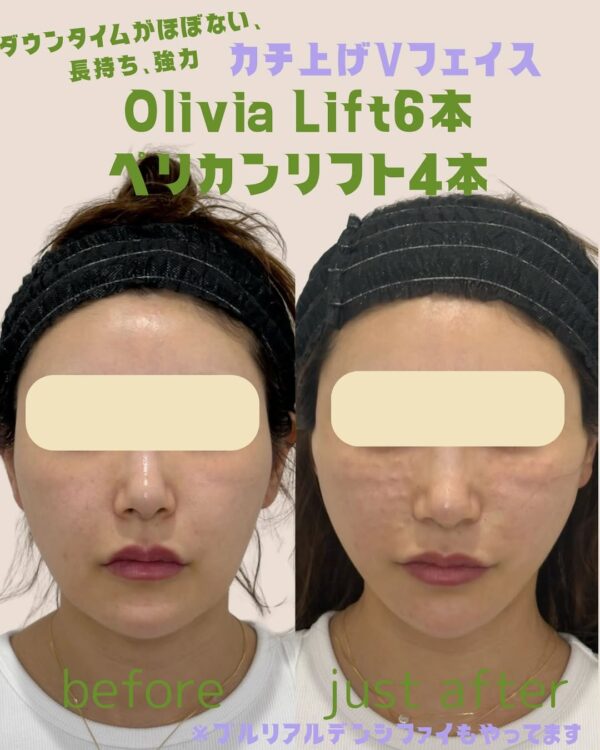 162 Olivia lift × ペリカンリフト