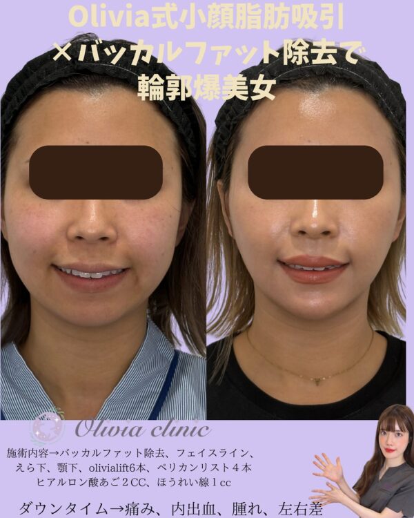 164 Olivia式小顔脂肪吸引 × バッカルファット除去 × Olivia lift × ペリカンリフト × ヒアルロン酸 × ほうれい線