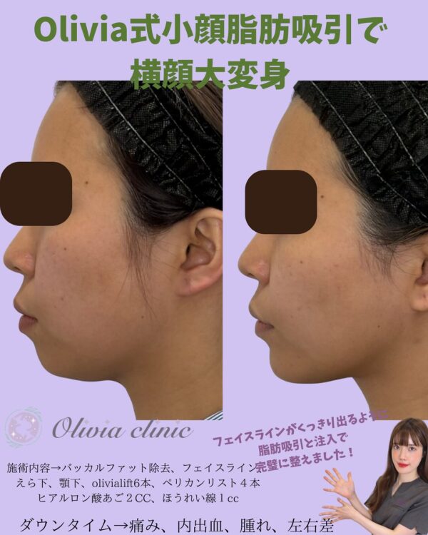 165 Olivia式小顔脂肪吸引 × バッカルファット除去 × Olivia lift × ペリカンリフト × ヒアルロン酸 × ほうれい線