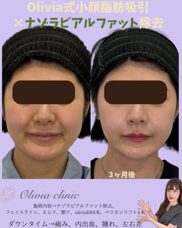 167 Olivia式小顔脂肪吸引 × ナゾラビアルファット除去 × ペリカンリフト × Olivia lift