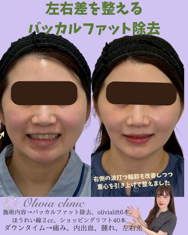 170 バッカルファット除去 × Olivia lift × 脂肪注入 × ショッピングリフト