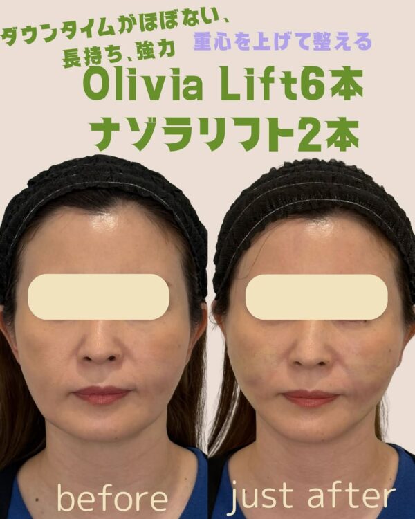 171 Olivia lift × ナゾラリフト