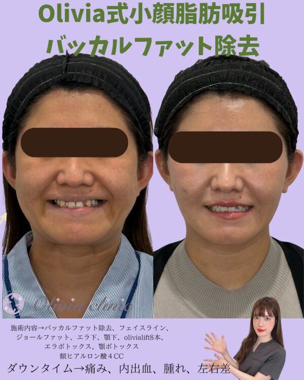 172 Olivia式小顔脂肪吸引 × バッカルファット除去 × ジョールファット除去 × Olivia lift × ボトックス × ヒアルロン酸