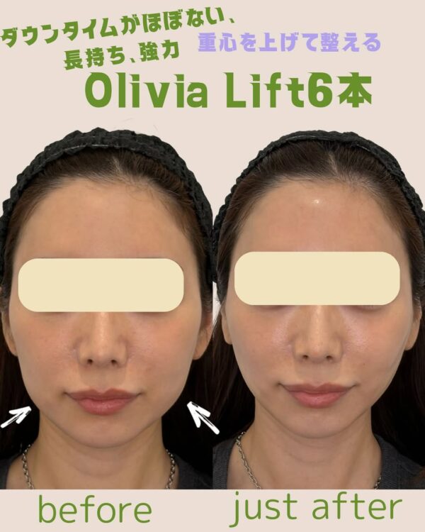 173 Olivia lift