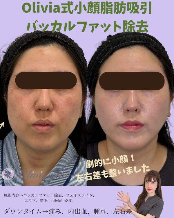 175 Olivia式小顔脂肪吸引 × バッカルファット除去  × Olivia lift