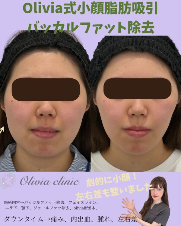 177 Olivia式小顔脂肪吸引 × バッカルファット除去  × ジョールファット除去× Olivia lift