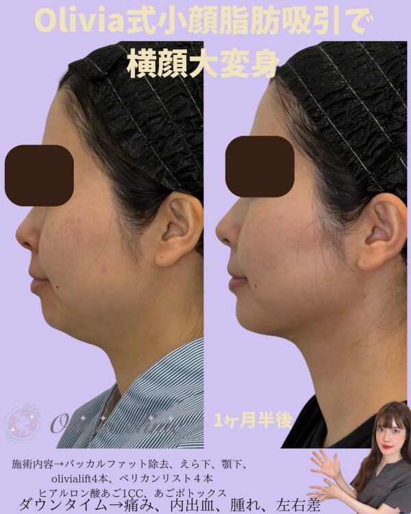 180 Olivia式小顔脂肪吸引 × バッカルファット除去 × Olivia lift × ペリカンリフト × ヒアルロン酸 × ボトックス