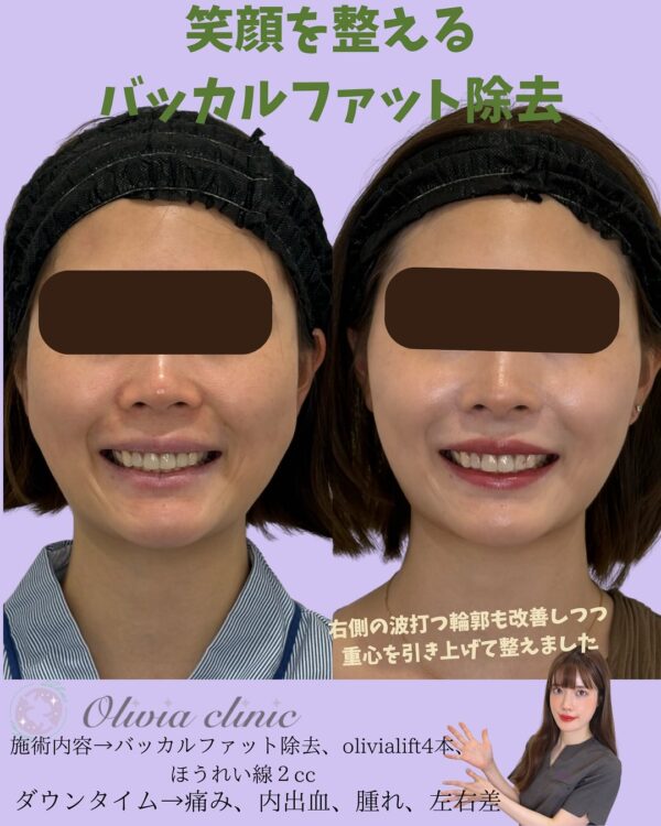 183 olivia式小顔脂肪吸引 × バッカルファット除去 × Olivia lift × ほうれい線