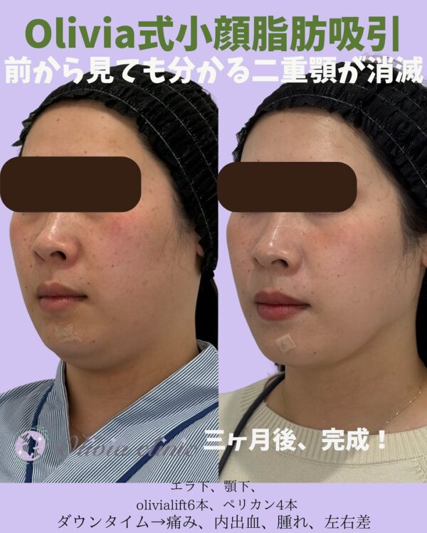 188 Olivia式小顔脂肪吸引 ×Olivia lift × ペリカンリフト