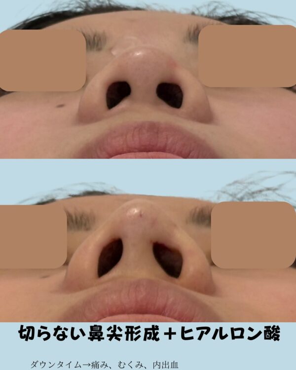 194 切らない鼻尖形成 × ヒアルロン酸