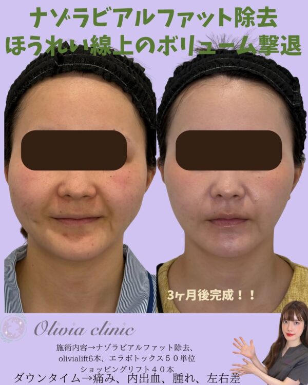195 Olivia式小顔脂肪吸引 × ナゾラビアルファット除去 × ショッピングリフト × Olivia lift × ボトックス