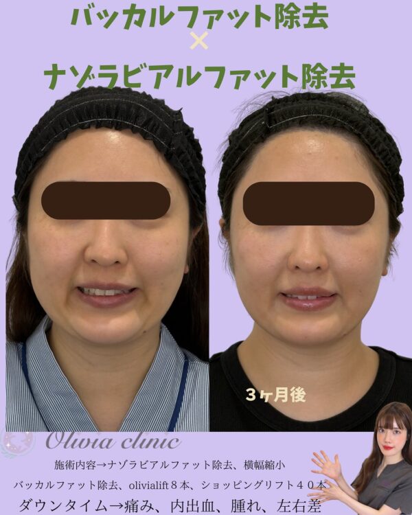 196 Olivia式小顔脂肪吸引 × バッカルファット除去 × ナゾラビアルファット除去 × 横幅縮小 × Olivia lift × ショピングリフト