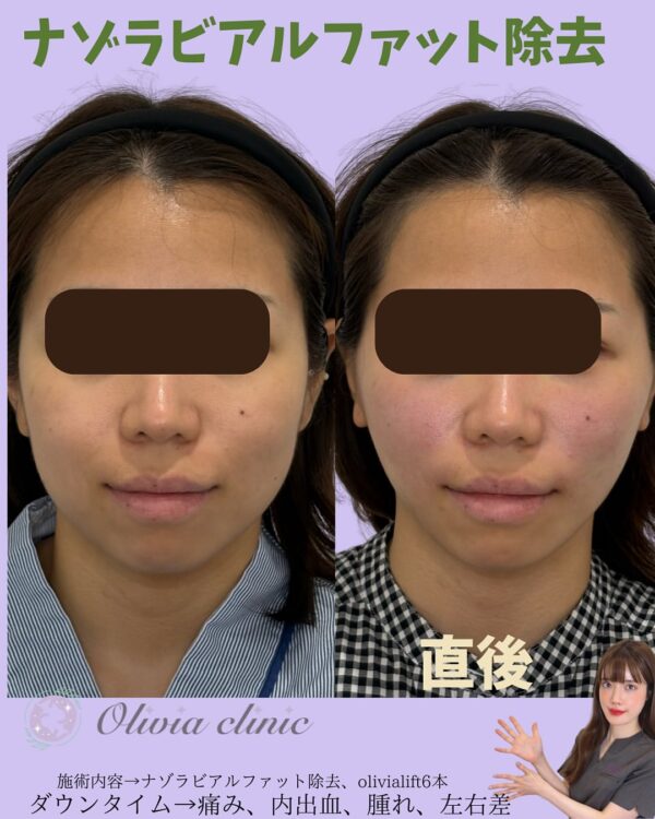 198 Olivia式小顔脂肪吸引 × ナゾラビアルファット除去 × Olivia lift