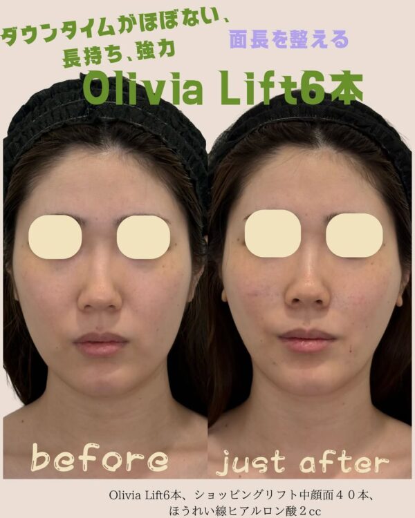201 Olivia lift × ショッピングリフト × ほうれい線ヒアルロン酸