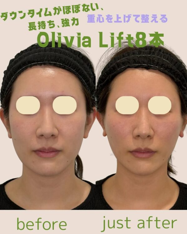 202 Olivia lift