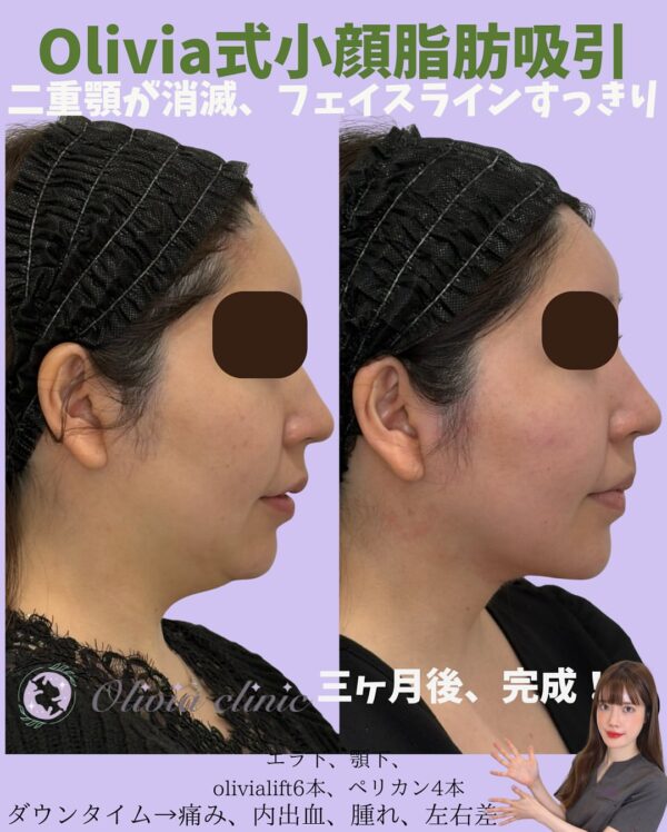 203 Olivia式小顔脂肪吸引 × Olivia lift × ペリカンリフト