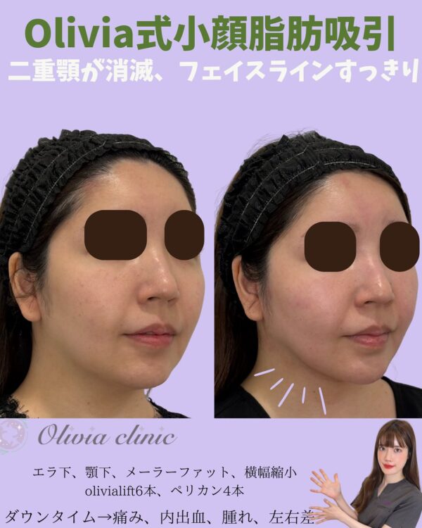 204 Olivia式小顔脂肪吸引 × メーラーファット除去 × 横幅縮小 × Olivia lift × ペリカンリフト