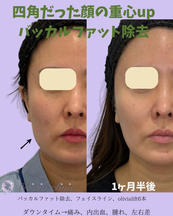 206 Olivia式小顔脂肪吸引 × バッカルファット除去  × Olivia lift × ヒアルロン酸
