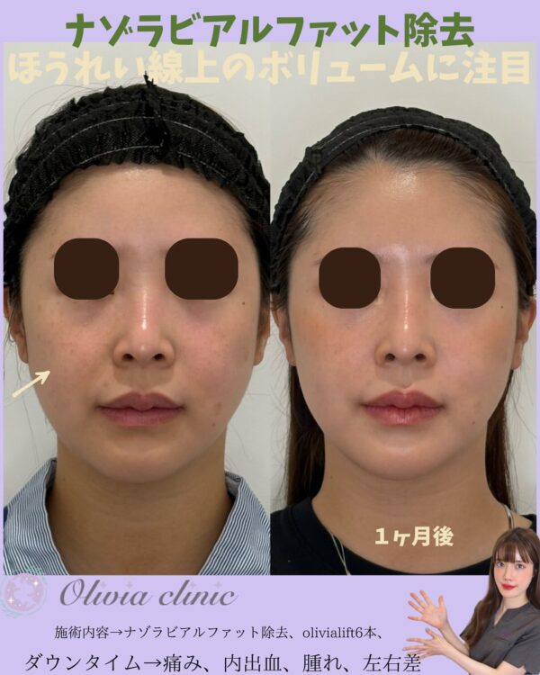 208 Olivia式小顔脂肪吸引 × ナゾラビアルファット除去 × Olivia lift