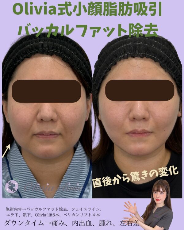 210 Olivia式小顔脂肪吸引 × バッカルファット除去 × Olivia lift × ペリカンリフト