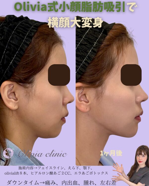 212 Olivia式小顔脂肪吸引 ×Olivia lift × ヒアルロン酸 × ボトックス注射