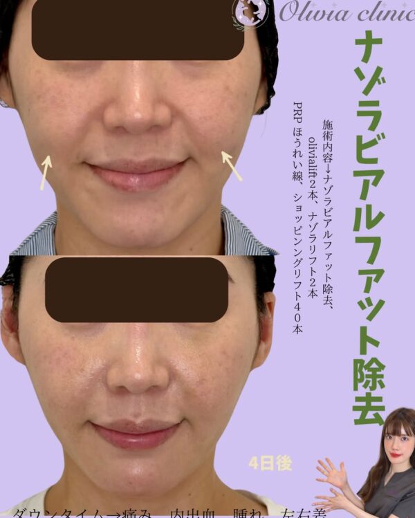 215 Olivia式小顔脂肪吸引 × ナゾラビアルファット除去 × Olivia lift × ナゾラリフト × PRPほうれい線 × ショッピングリフト