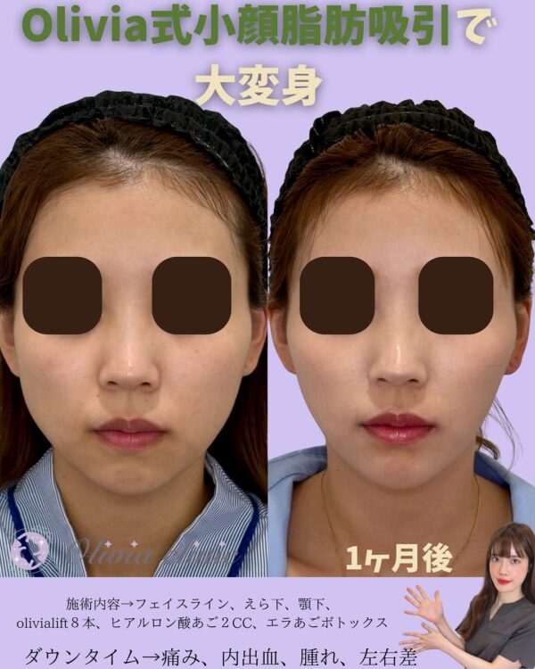216 Olivia式小顔脂肪吸引 ×Olivia lift × ヒアルロン酸 × ボトックス注射