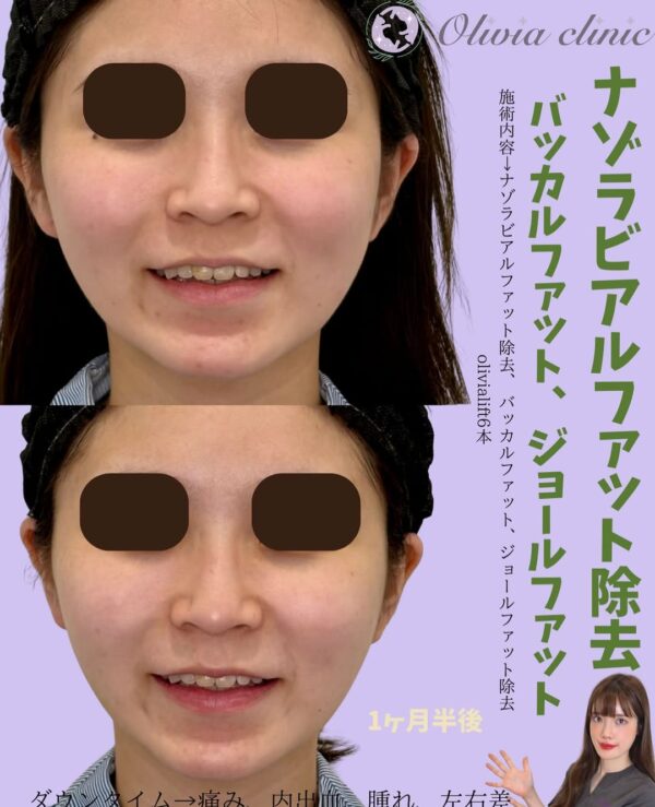 217 Olivia式小顔脂肪吸引 × × ナゾラビアルファット除去 × バッカルファット除去  × ジョールファット除去× Olivia lift