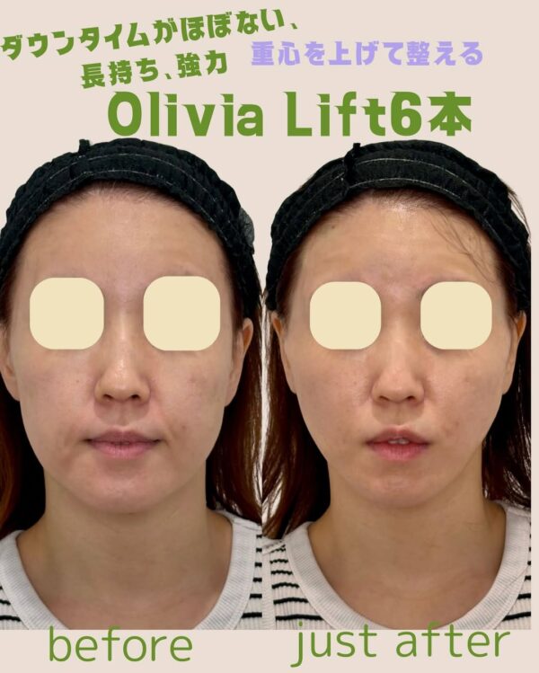 218 Olivia lift