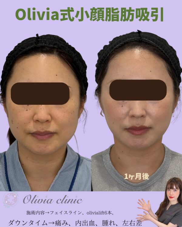 220 Olivia式小顔脂肪吸引 × Olivia lift