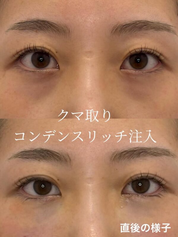 221 クマ取り（脱脂） × コンデンスリッチ脂肪注入