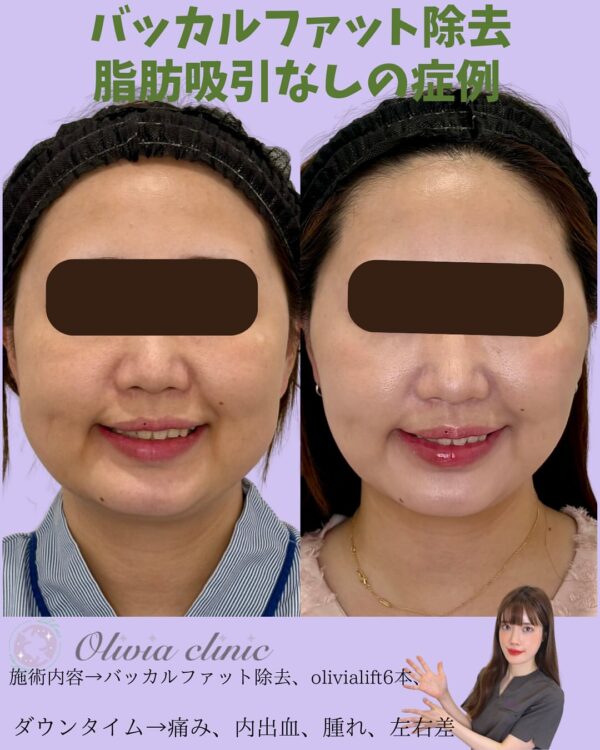 223 バッカルファット除去  × Olivia lift