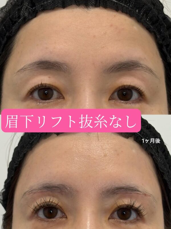 224 眉下リフト抜糸なし