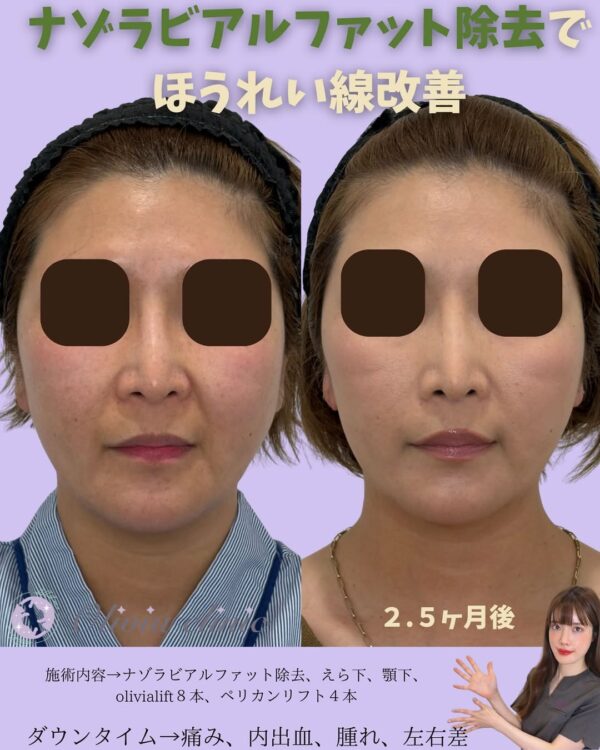 225 Olivia式小顔脂肪吸引 × ナゾラビアルファット除去 × Olivia lift × ペリカンリフト