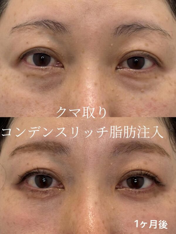 227 クマ取り（脱脂） × コンデンスリッチ脂肪注入
