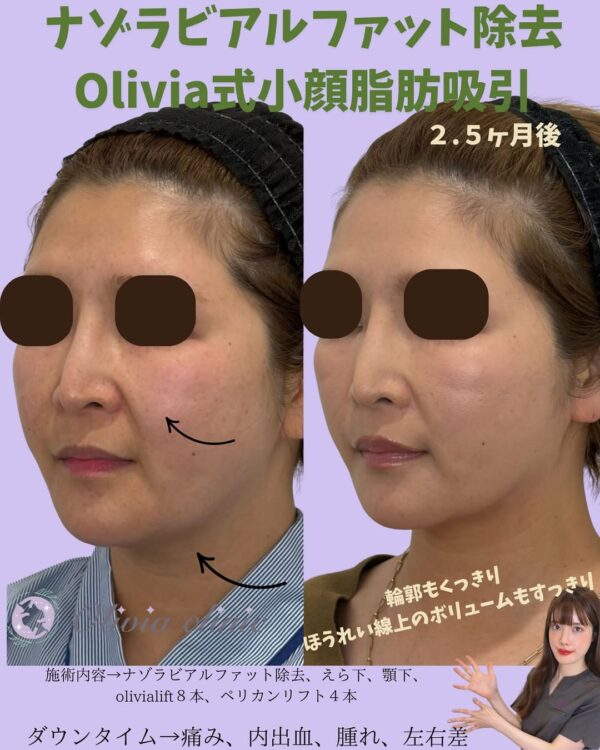 228 Olivia式小顔脂肪吸引 × ナゾラビアルファット除去 × Olivia lift × ペリカンリフト