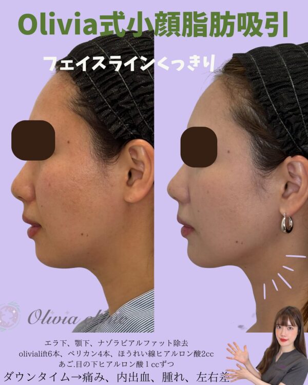 230 Olivia式小顔脂肪吸引 × ナゾラビアルファット除去 × Olivia lift × ペリカンリフト × ヒアルロン酸